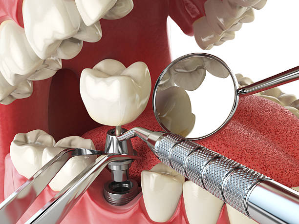 Best Emergency Treatment for Dental Infections or Abscesses in Santa Rosa Valley, CA